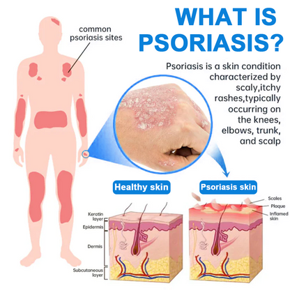 -50%OFF(🌲Early Christmas Sale🎁) Zvoevo® Magnesium Herbal Psoriasis Spray 👨‍⚕️ FDA Approved (Relieves psoriasis and eczema, improves bacterial infections in the genital area, hidradenitis suppurativa)