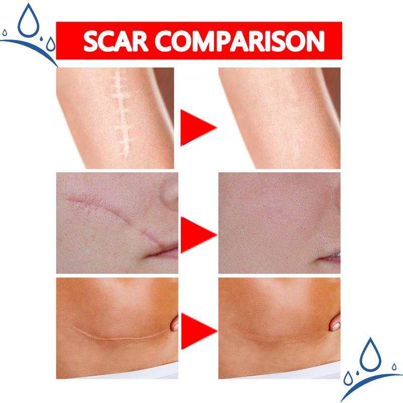 Professional and powerful scar removal gel - suitable for scar removal treatment of post-operative scars, caesarean section scars, keloids, burns, acne