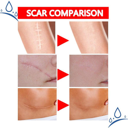 Professional and powerful scar removal gel - suitable for scar removal treatment of post-operative scars, caesarean section scars, keloids, burns, acne