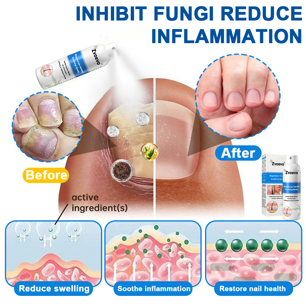 -50%OFF(🌲Early Christmas Sale🎁) Zvoevo® Magnesium Herbal Psoriasis Spray 👨‍⚕️ FDA Approved (Relieves psoriasis and eczema, improves bacterial infections in the genital area, hidradenitis suppurativa)